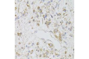 Immunohistochemistry of paraffin-embedded human gastric cancer using CIAPIN1 Antibody. (CIAPIN1 anticorps  (AA 1-312))