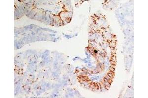 Immunohistochemical analysis of paraffin-embedded mammary cancer sections, staining MORG1 in cytoplasm, DAB staining (MORG1 anticorps  (N-Term))
