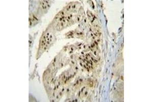 Immunohistochemistry analysis in formalin fixed and paraffin embedded human prostate carcinoma reacted with AP53159PU-N, which was peroxidase conjugated to the secondary antibody and followed by DAB staining. (PAPOLA anticorps  (Middle Region))