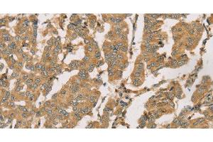 Immunohistochemistry of paraffin-embedded Human breast cancer using DMRT3 Polyclonal Antibody at dilution of 1:50 (DMRT3 anticorps)