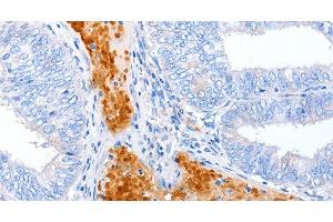 Immunohistochemistry of paraffin-embedded Human cervical cancer using ENPP7 Polyclonal Antibody at dilution of 1:50
