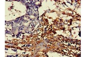 Immunohistochemistry of paraffin-embedded human gastric cancer using ABIN7149454 at dilution of 1:100