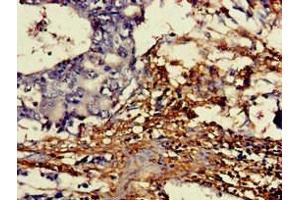 Immunohistochemistry of paraffin-embedded human gastric cancer using ABIN7149454 at dilution of 1:100 (DDO anticorps  (AA 37-161))