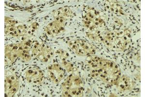 ABIN6267184 at 1/100 staining Human breast cancer tissue by IHC-P. (SQSTM1 anticorps  (pSer272, pThr269))