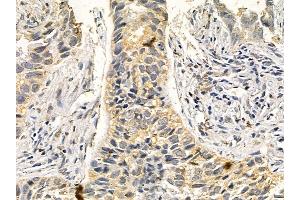 DNALI1 Mouse Monoclonal Antibody at 1/100 staining human lung cancer and adjacent non-tumor tissue by IHC-P. (DNALI1 anticorps)