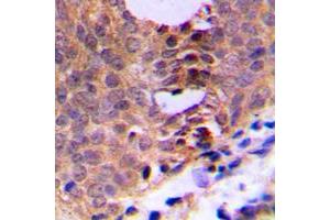 Immunohistochemical analysis of CDC2 (pT161) staining in human breast cancer formalin fixed paraffin embedded tissue section. (CDK1 anticorps  (pSer161))