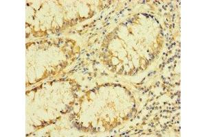 Immunohistochemistry of paraffin-embedded human colon cancer using ABIN7142550 at dilution of 1:100