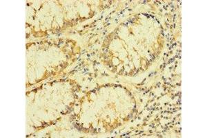 Immunohistochemistry of paraffin-embedded human colon cancer using ABIN7142550 at dilution of 1:100 (FAU anticorps  (AA 1-59))