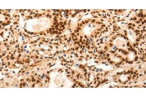 Immunohistochemistry of paraffin-embedded Human gasrtic cancer tissue using E2F7 Polyclonal Antibody at dilution 1:60 (E2F7 anticorps)