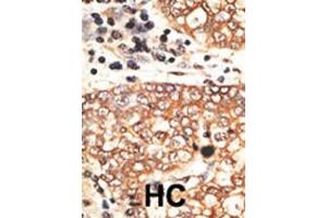 Formalin-fixed and paraffin-embedded human cancer tissue reacted with the primary antibody, which was peroxidase-conjugated to the secondary antibody, followed by AEC staining.