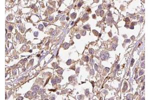 ABIN6267501 at 1/100 staining human breast carcinoma tissue sections by IHC-P. (p21 anticorps  (pThr145))