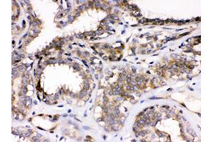 Anti- Parvin alpha Picoband antibody, IHC(P) IHC(P): Human Mammary Cancer Tissue
