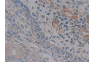 Detection of NOS2 in Human Skin cancer Tissue using Polyclonal Antibody to Nitric Oxide Synthase 2, Inducible (NOS2)