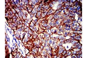 Immunohistochemical analysis of paraffin-embedded ovarian cancer tissues using CD147 mouse mAb with DAB staining.