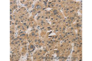 Immunohistochemistry of Human gastric cancer using DDIT4 Polyclonal Antibody at dilution of 1:30 (DDIT4 anticorps)