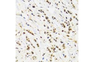 Immunohistochemistry of paraffin-embedded human breast cancer using RAD50 Antibody. (RAD50 anticorps)