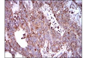 Immunohistochemical analysis of paraffin-embedded ovarian cancer tissues using STAT5A mouse mAb with DAB staining. (STAT5A anticorps  (AA 583-794))