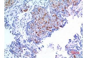Immunohistochemistry (IHC) analysis of paraffin-embedded Human Mammary Cancer, antibody was diluted at 1:100. (pan Keratin anticorps  (pan))
