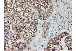 Immunohistochemical staining of paraffin-embedded Adenocarcinoma of Human ovary tissue using anti-PDSS2 mouse monoclonal antibody. (PDSS2 anticorps)