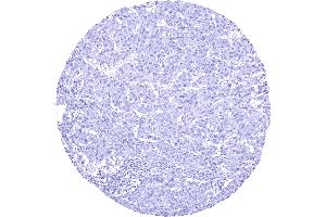 Hepatocellular carcinoma without AGR2 staining of tumor cells