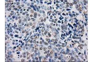 Immunohistochemical staining of paraffin-embedded Adenocarcinoma of ovary tissue using anti-GBE1 mouse monoclonal antibody. (GBE1 anticorps)