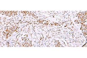 Immunohistochemistry of paraffin-embedded Human ovarian cancer tissue using HSF2BP Polyclonal Antibody at dilution of 1:30(x200) (HSF2BP anticorps)