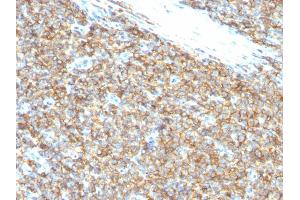 Formalin-fixed, paraffin-embedded human Ewing's Sarcoma stained with CD99 Monoclonal Antibody (12E7). (CD99 anticorps)