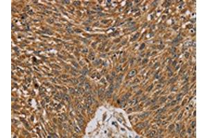 The image on the left is immunohistochemistry of paraffin-embedded Human lung cancer tissue using ABIN7130359(NDEL1 Antibody) at dilution 1/20, on the right is treated with fusion protein. (NDEL1 anticorps)
