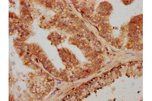 IHC image of ABIN7172814 diluted at 1:600 and staining in paraffin-embedded human prostate cancer performed on a Leica BondTM system.