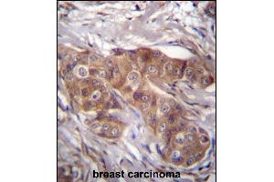 LR6 Antibdy (Center) (ABIN656635 and ABIN2845880) immunohistochemistry analysis in formalin fixed and raffin embedded human breast carcinoma followed by peroxidase conjugation of the secondary antibody and DAB staining.