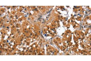 Immunohistochemistry of paraffin-embedded Human thyroid cancer tissue using CAMK1D Polyclonal Antibody at dilution 1:50 (CAMK1D anticorps)
