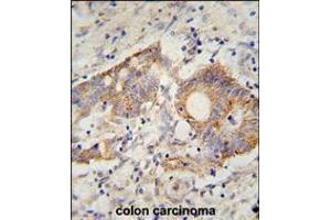 HHLA2 Antibody immunohistochemistry analysis in formalin fixed and paraffin embedded human colon carcinoma followed by peroxidase conjugation of the secondary antibody and DAB staining. (HHLA2 anticorps  (N-Term))