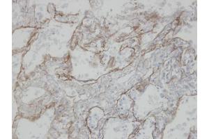 IHC-P Image Immunohistochemical analysis of paraffin-embedded human T(IV)(lung CA), using CLIC3, antibody at 1:100 dilution. (CLIC3 anticorps)