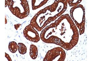Formalin-fixed, paraffin-embedded human Colon stained with Cytokeratin 19 Mouse Monoclonal Antibody (BA17) (Cytokeratin 19 anticorps)