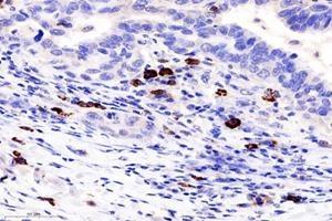 Immunohistochemistry analysis of paraffin-embedded human lung cancer using TCRb (ABIN7075813) at dilution of 1: 1800 (TCRb anticorps)