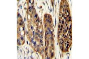 Immunohistochemistry analysis in formalin fixed and paraffin embedded human esophagus carcinoma reacted with KIAA1324L Antibody (N-term) followed which was peroxidase conjugated to the secondary antibody and ollowed by DAB staining. (KIAA1324-Like anticorps  (N-Term))