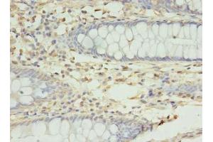Immunohistochemistry of paraffin-embedded human colon cancer using ABIN7166018 at dilution of 1:100 (RMND5B anticorps  (AA 1-260))