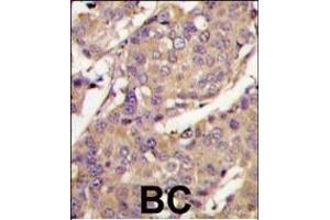 Formalin-fixed and paraffin-embedded breast carcinoma tissue reacted with UBE2L6 Antibody (C-term) (ABIN388854 and ABIN2839156) , which was peroxidase-conjugated to the secondary antibody, followed by DAB staining. (UBE2L6 anticorps  (C-Term))
