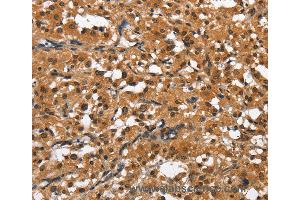 Immunohistochemistry of Human gastric cancer using SLAMF8 Polyclonal Antibody at dilution of 1:50