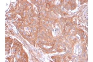 Formalin-fixed, paraffin-embedded human Colon Carcinoma stained with CD73 Mouse Monoclonal Antibody (NT5E/2545).