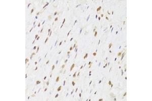 Immunohistochemistry of paraffin-embedded human gastric cancer using RUVBL1 Antibody. (RUVBL1 anticorps  (AA 1-240))