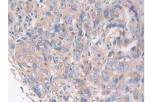 Detection of CAP2 in Human Breast cancer Tissue using Polyclonal Antibody to Adenylyl Cyclase Associated Protein 2 (CAP2)