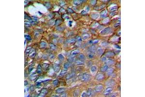 Immunohistochemical analysis of IL-12A staining in human prostate cancer formalin fixed paraffin embedded tissue section. (IL12A anticorps  (Center))