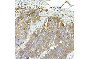 Immunohistochemistry of paraffin-embedded human esophageal cancer using IFIH1 Rabbit pAb (ABIN6131879, ABIN6142174, ABIN6142175 and ABIN6217724) at dilution of 1:50 (40x lens).