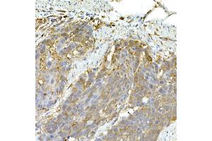 Immunohistochemistry of paraffin-embedded human esophageal cancer using IFIH1 Rabbit pAb (ABIN6131879, ABIN6142174, ABIN6142175 and ABIN6217724) at dilution of 1:50 (40x lens). (IFIH1 anticorps  (AA 1-205))