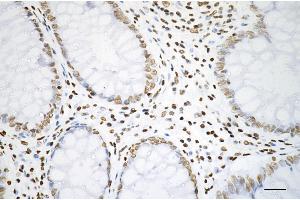 Immunohistochemistry was performed on paraffin-embedded human sigmoid colon carcinoma using histone H3 (acetyl K27) antibody (ABIN7798971), 1:200). (Recombinant Histone 3 anticorps  (H3K27ac))
