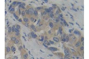 Detection of PFKP in Human Breast cancer Tissue using Polyclonal Antibody to Phosphofructokinase, Platelet (PFKP)