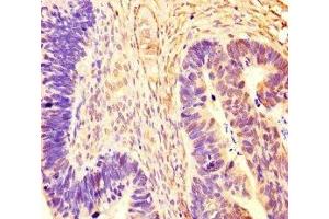 Immunohistochemistry of paraffin-embedded human ovarian cancer using ABIN7167721 at dilution of 1:100