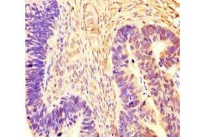 Immunohistochemistry of paraffin-embedded human ovarian cancer using ABIN7167721 at dilution of 1:100 (CoREST anticorps  (AA 394-482))