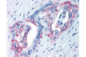 Anti-TRPM8 antibody IHC of human Pancreas, Carcinoma. (TRPM8 anticorps  (Internal Region))